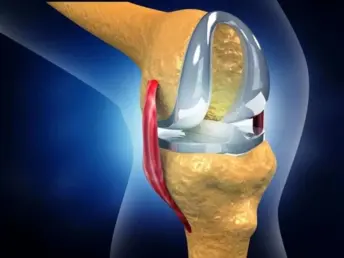 3D medical illustration of knee replacement surgery showing prosthetic implant components in knee joint